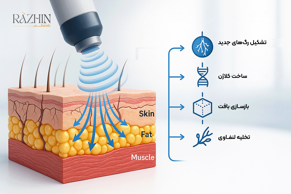 شاک ویو لاغری