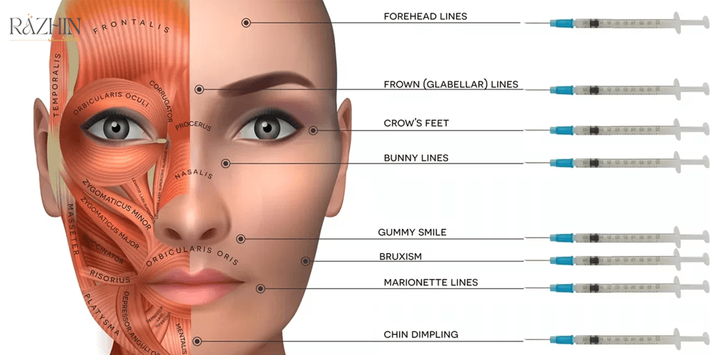 آموزش تزریق بوتاکس