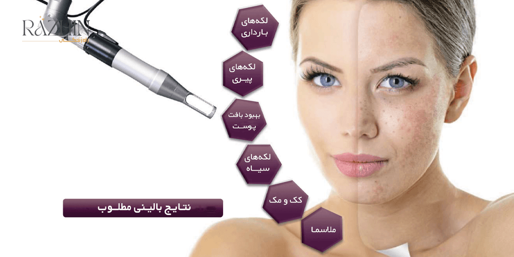 جدیدترین دستگاه لیزر کیوسوئیچ