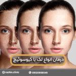 درمان لک با لیزر کیوسوئیچ