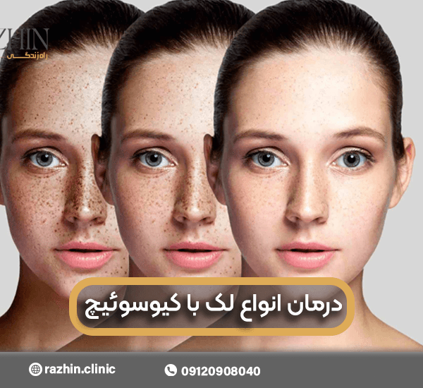 درمان لک با لیزر کیوسوئیچ