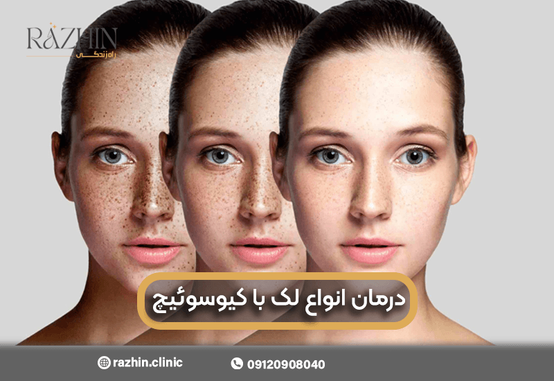 درمان لک با لیزر کیوسوئیچ