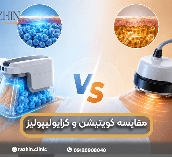 مقایسه کرایولیپولیز و کویتیشن