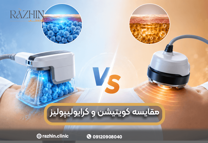 مقایسه کرایولیپولیز و کویتیشن